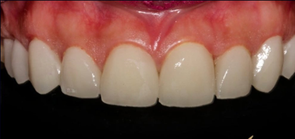 After treatment