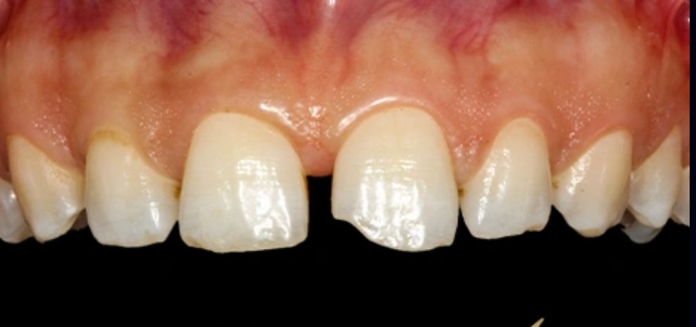 Before treatment