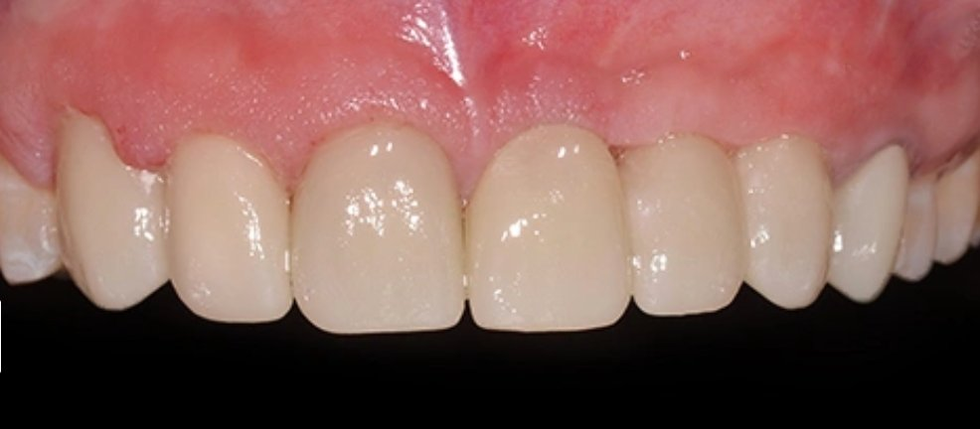 After treatment